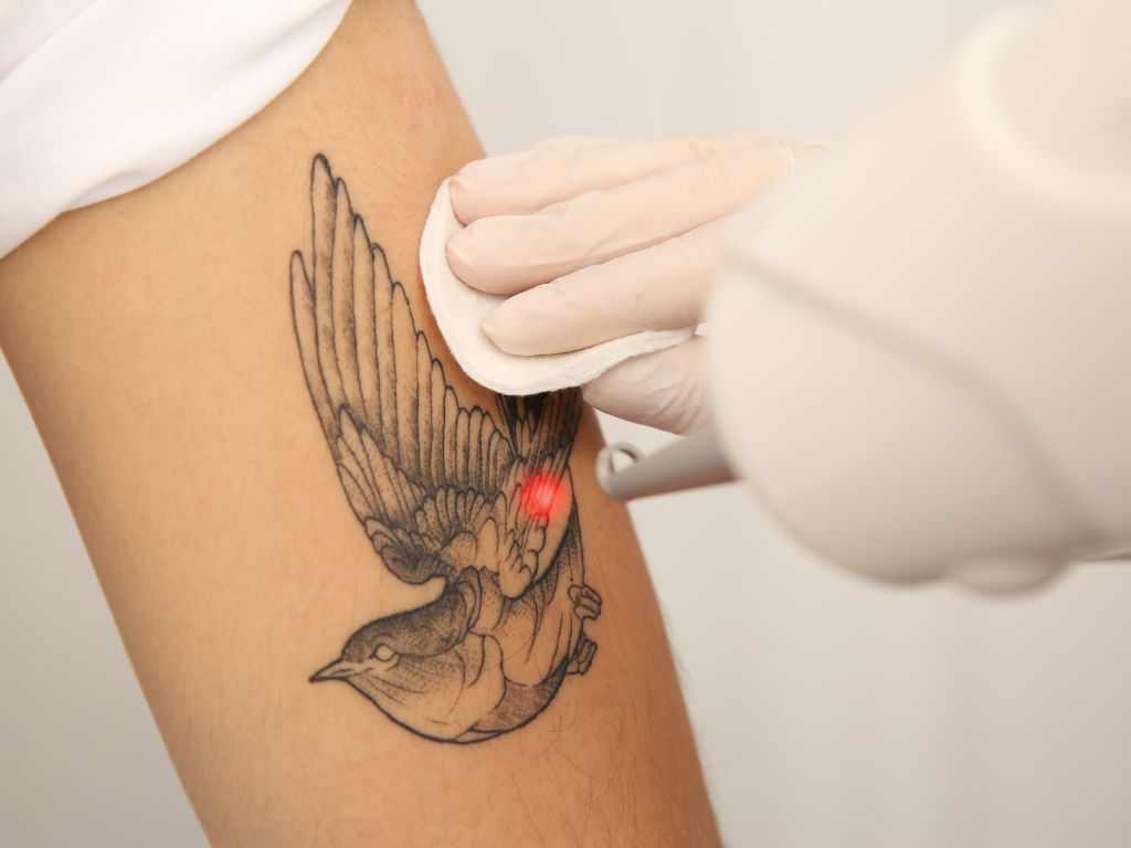 Eliminacion de Tatuajes en Fuengirola - CLINIVA Eliminación de tatuajes en Fuengirola